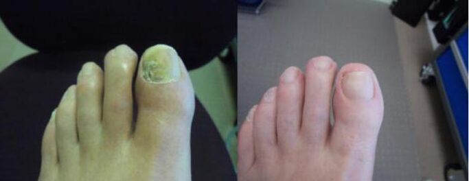 Fotod jalgadest enne ja pärast Zenidoli kreemi kasutamist