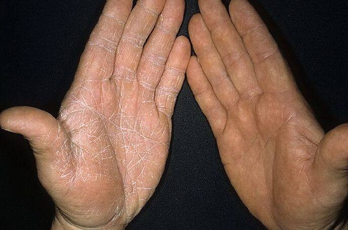 seene sümptomid käte nahal