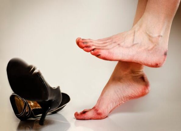 Varbaküüneseene teket võivad põhjustada kitsad jalanõud